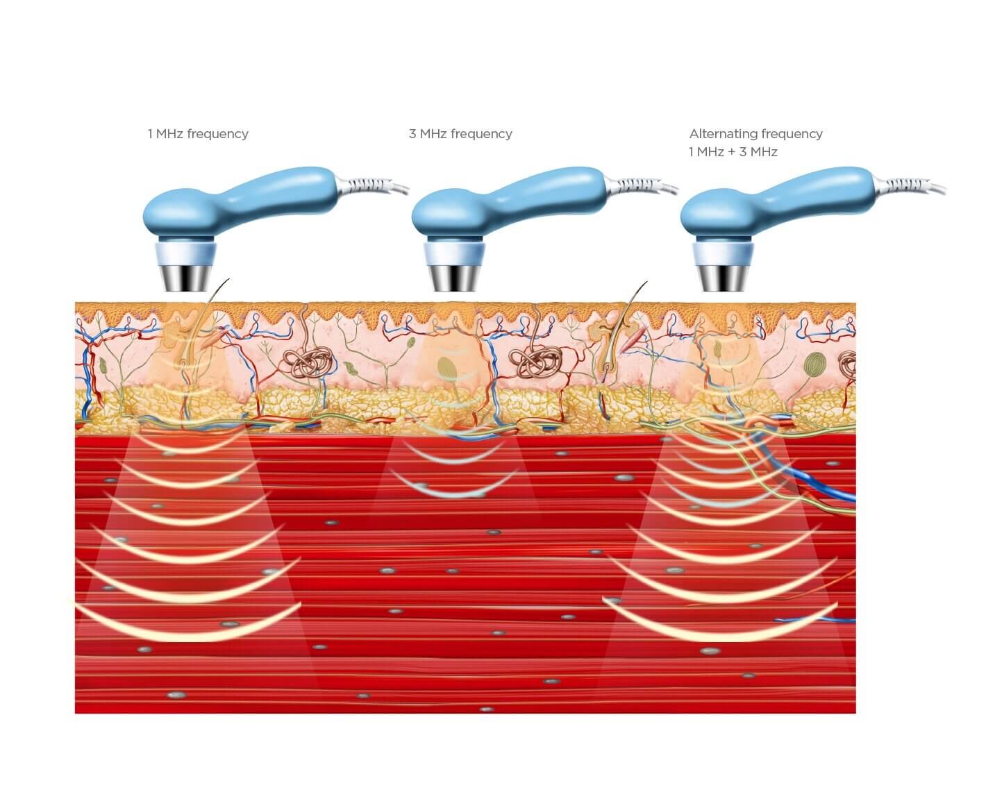 Ultraschall-Wirkverfahren des BTL-4825S Premium